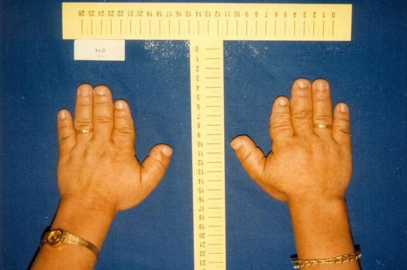 Perawakan jari pendek (Brakidaktili)